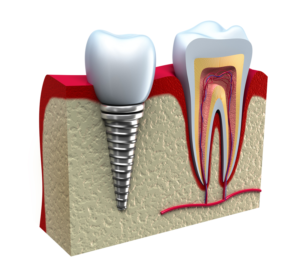 BOCCA Clinicas Dentales - Corona Metal-Porcelana sobre núcleo metálico. Si  se respetan las indicaciones, si se trabaja con materiales de excelente  calidad y si se hace una buena odontología el resultado es