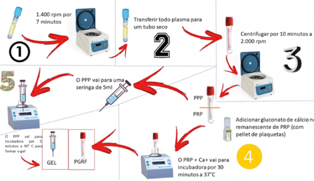 Gel de plasma para odontología: la belleza está en la sangre