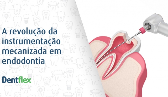 A revolução da instrumentação mecanizada em endodontia